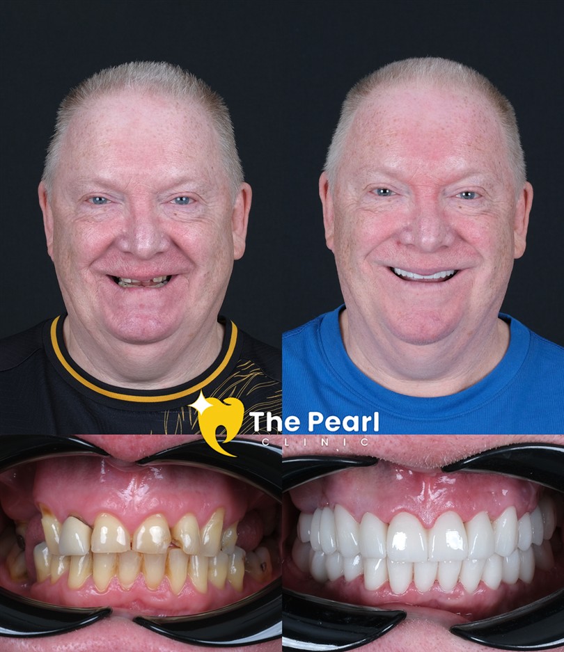 Before Dental Implant 1