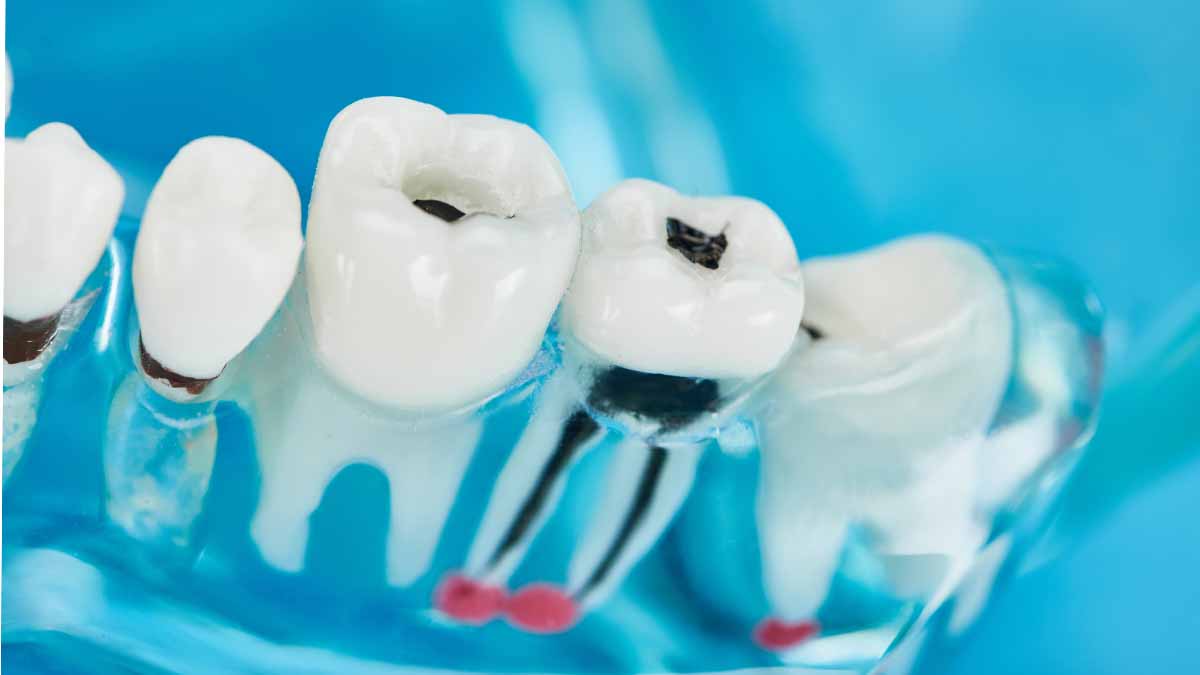 Dental Restorations Antalya Turkey