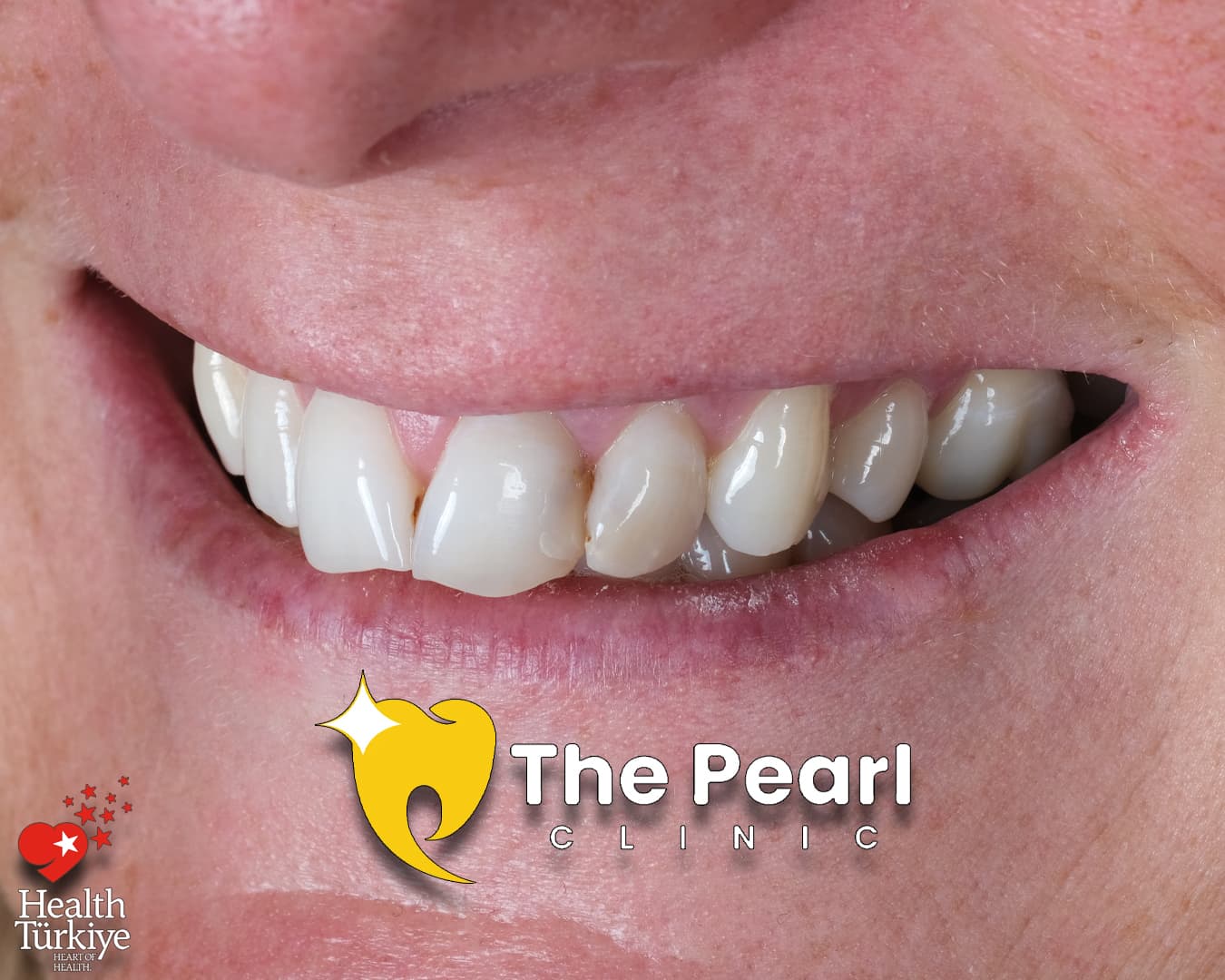 Zirconium Crowns OM1 Natural Smile Gallery The Pearl Antalya Dental Zirconium Crowns OM1 Natural Smile Gallery The Pearl Antalya Dental