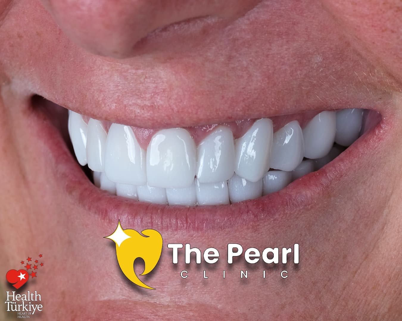 Zirconium Crowns OM1 Natural Smile Gallery The Pearl Antalya Dental Zirconium Crowns OM1 Natural Smile Gallery The Pearl Antalya Dental