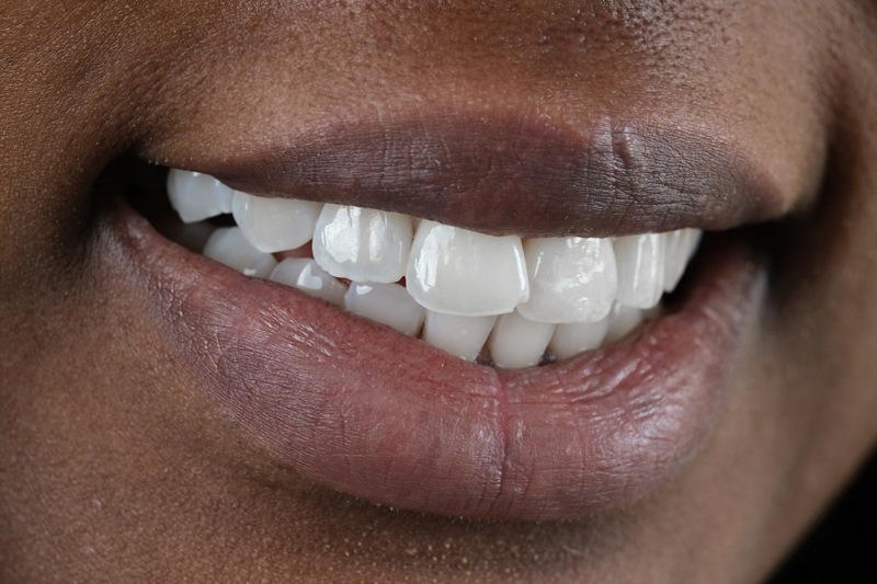 Professional teeth whitening at The Pearl Clinic Antalya