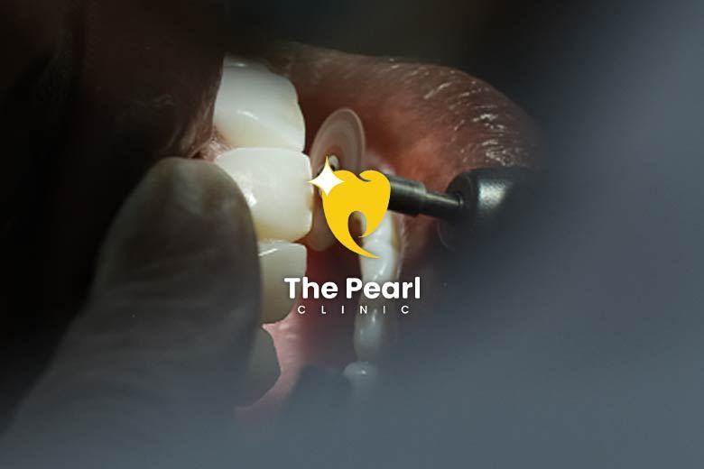 One Visit with Composite Bonding!