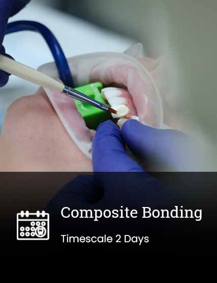 Composite Bonding  (Veneers)