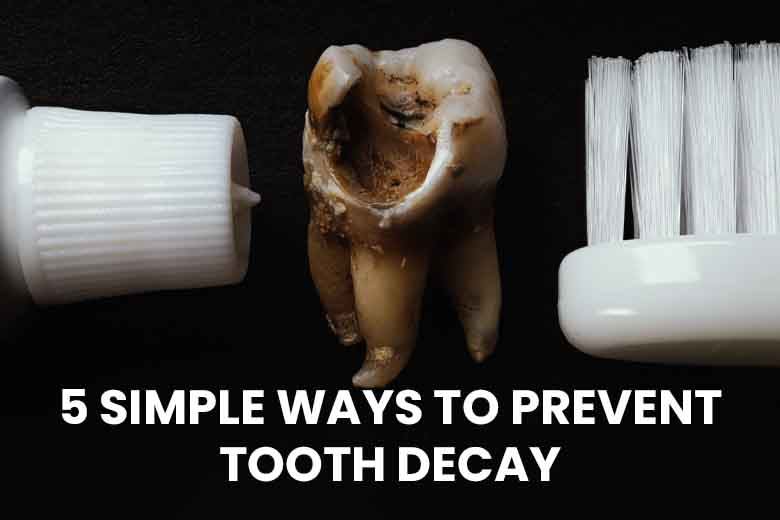 5 Easy Ways to Prevent Tooth Decay Before It Starts