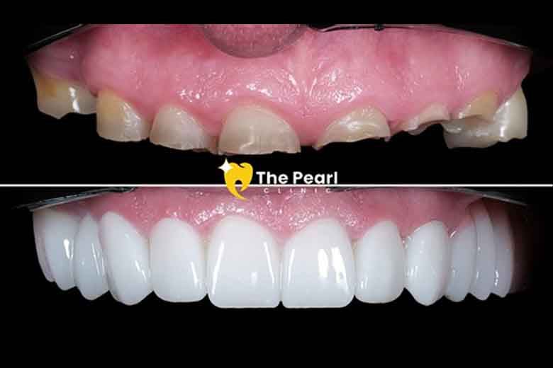 Can Worn Teeth Be Restored? Neil’s Bruxism Case Says Yes