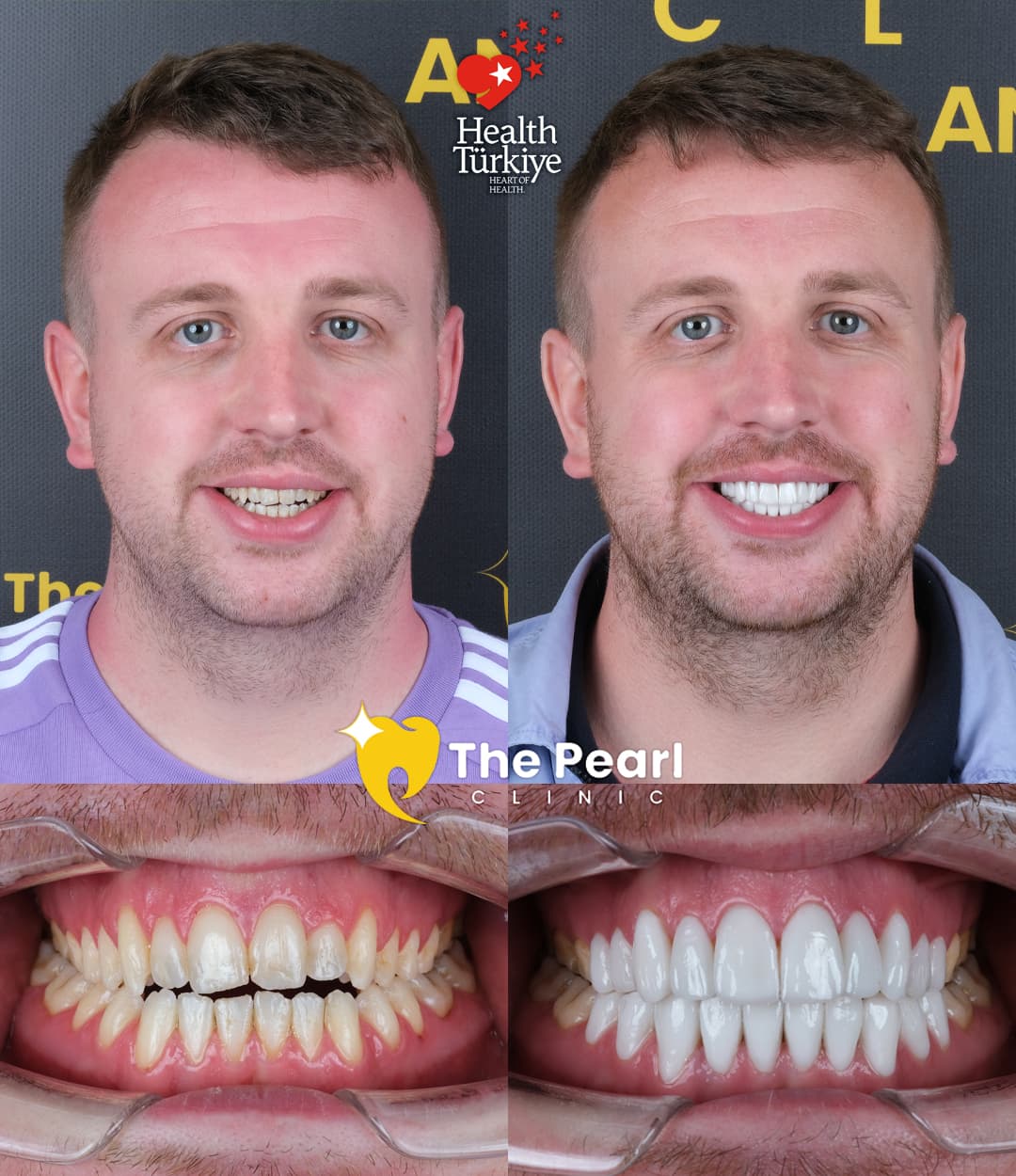 Laminate Veneer – BL2 -Natural Style