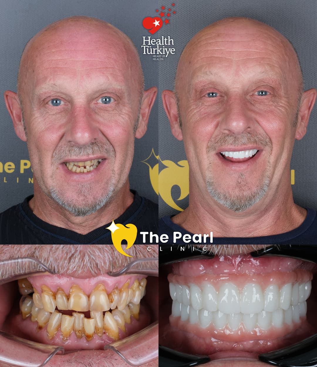 All-on-4  – BL3 -Mature Style