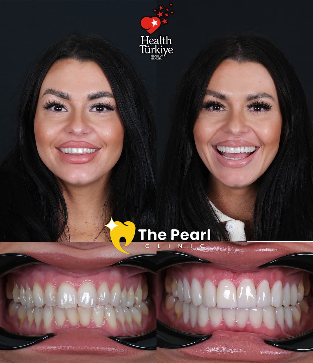 Laminate Veneer – BL2 -Natural Style