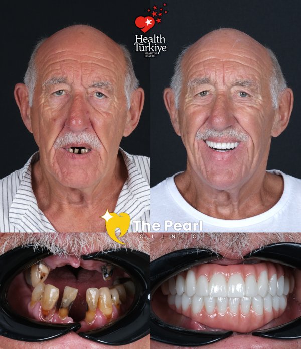 16 E-max Veneers – BL2 Shade