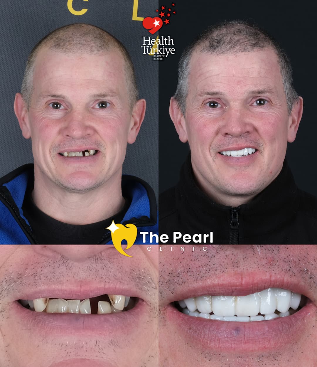 Temporary-Provisional Crown