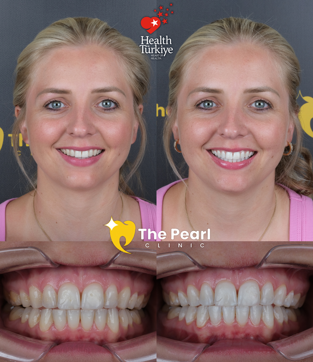 Отбеливание