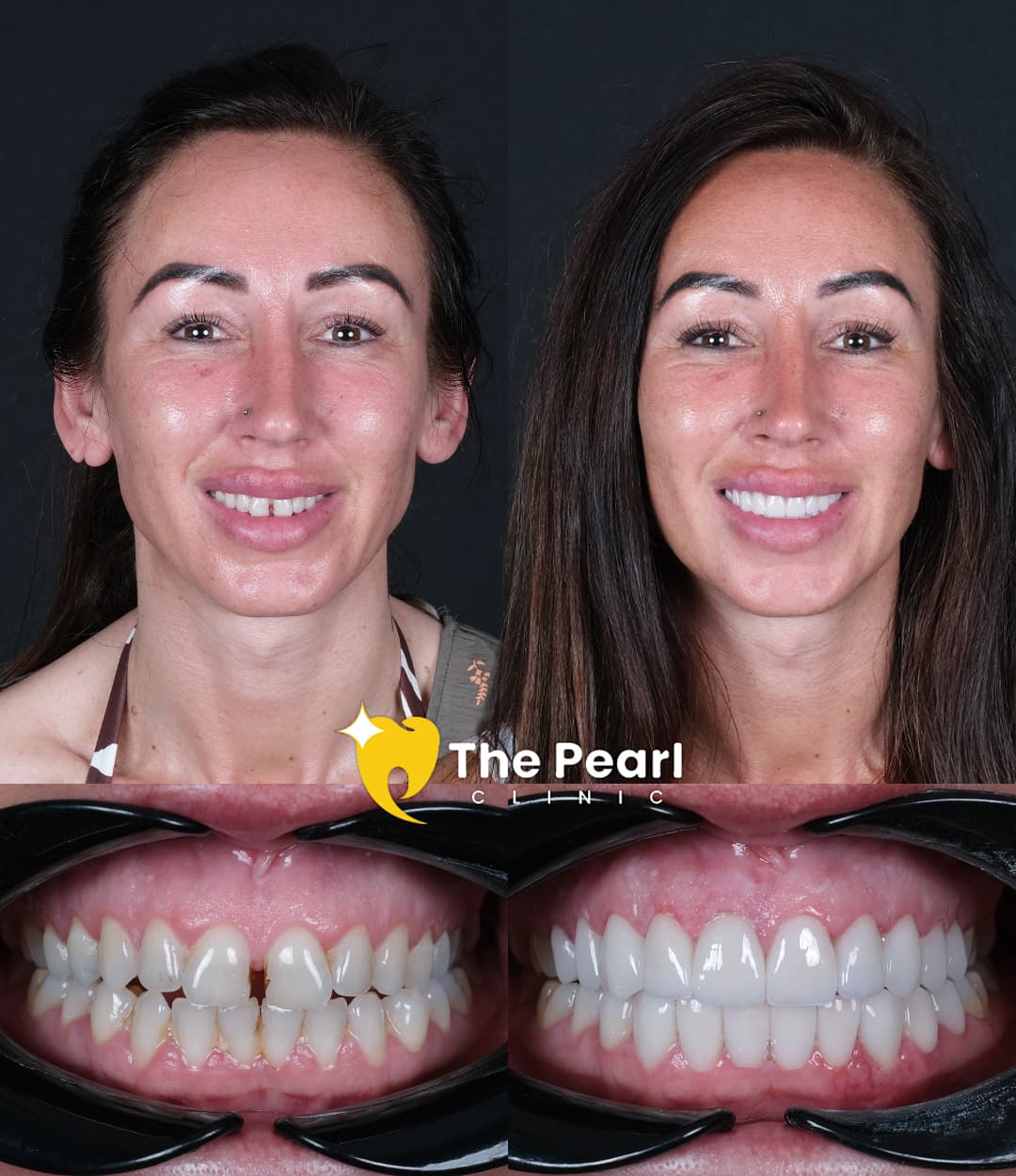 Laminate Veneer – BL2 -Natural Style