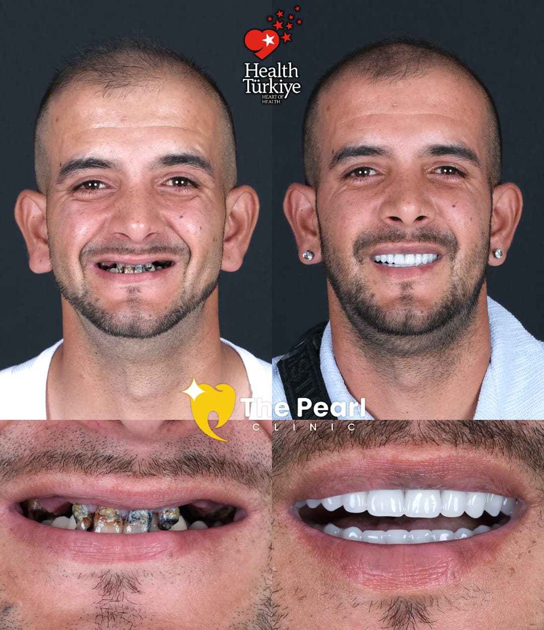 Temporary-Provisional Crown