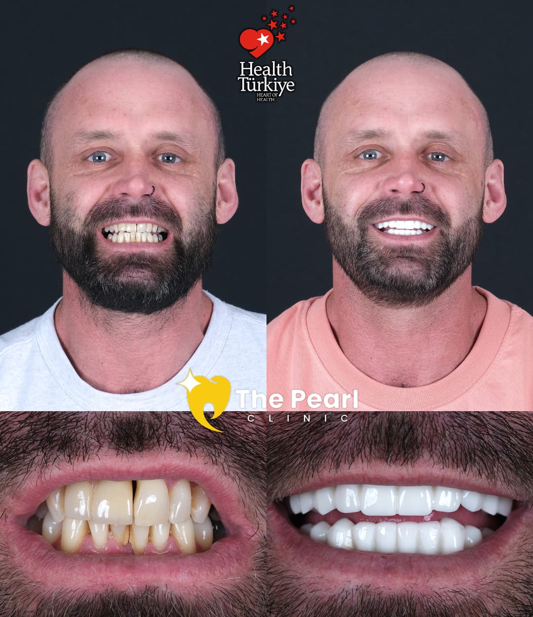 Temporary-Provisional Crown