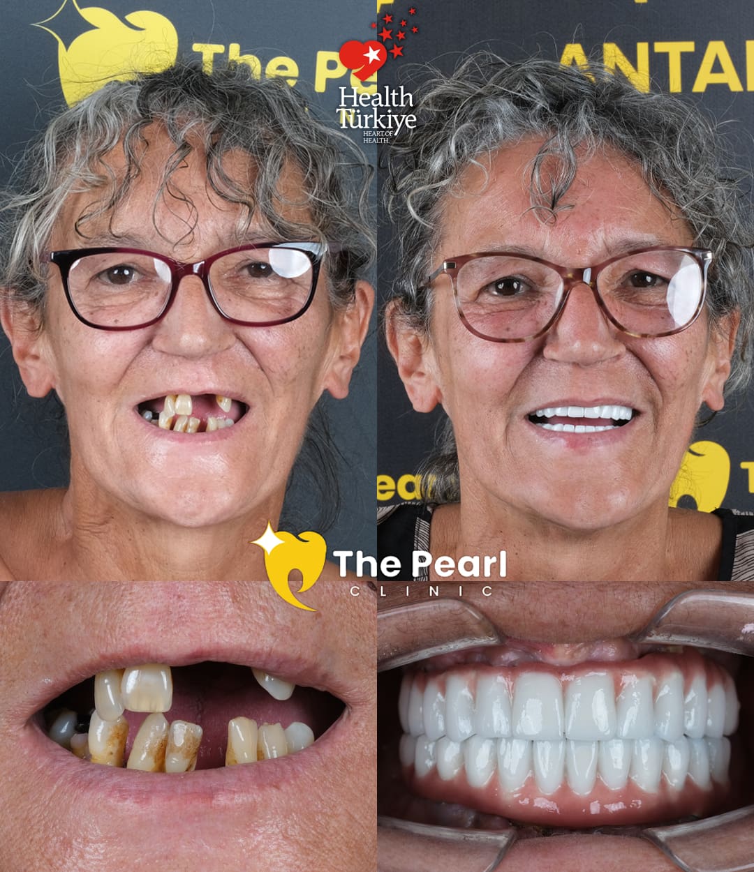 All-on-6  – BL3 -Natural Style