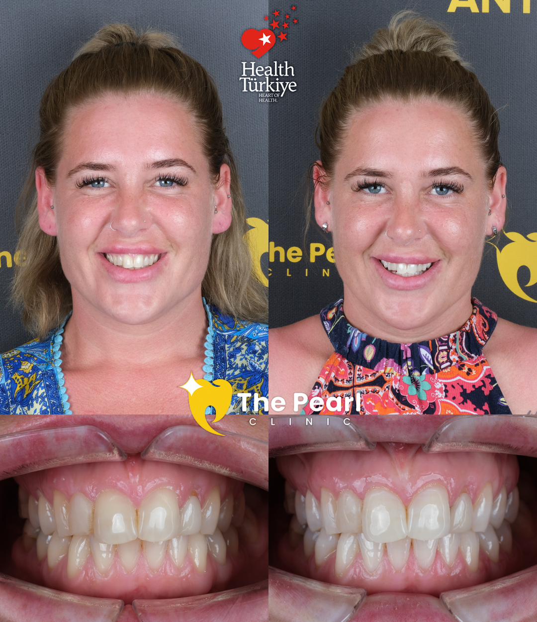 Отбеливание