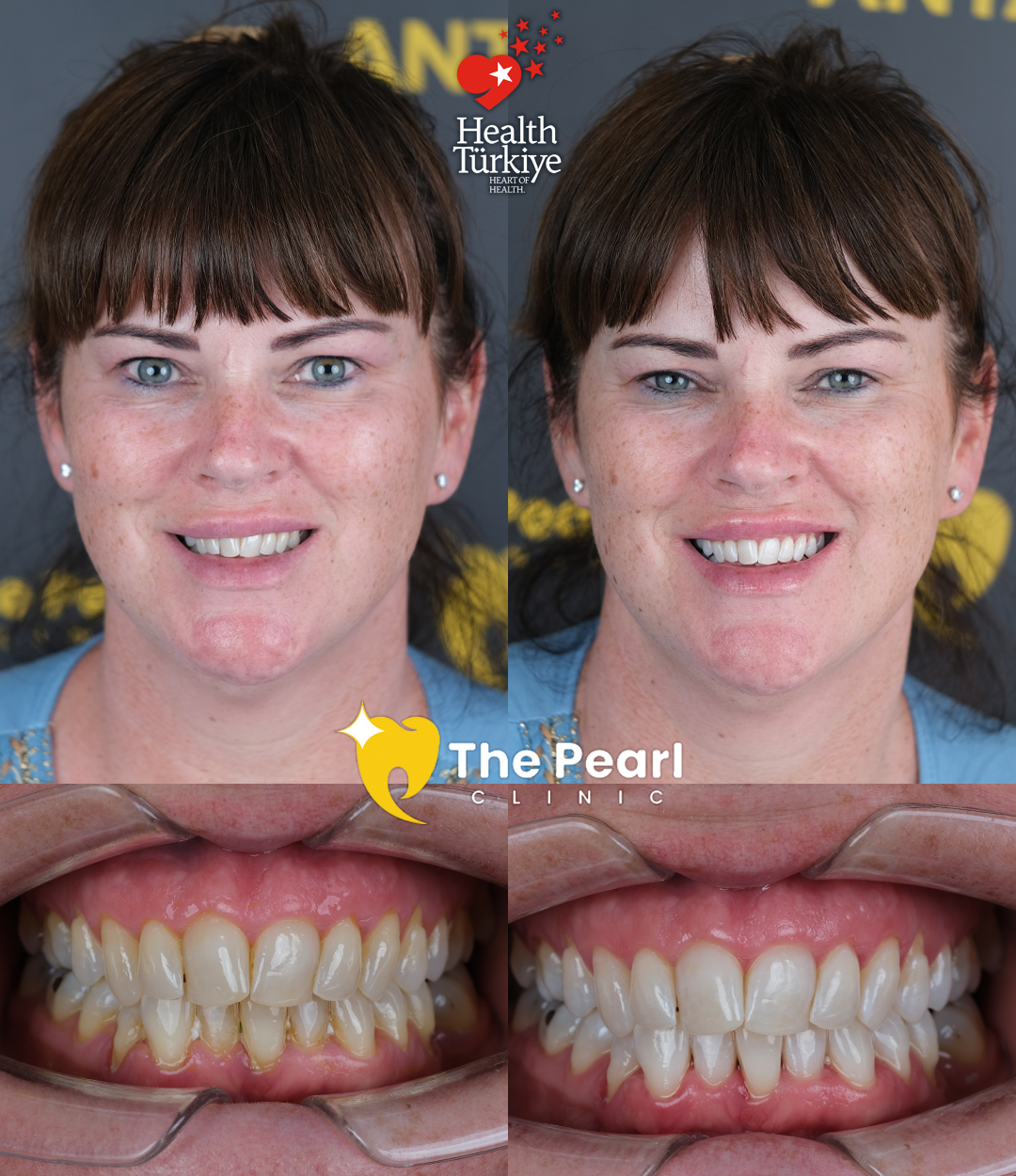 Отбеливание