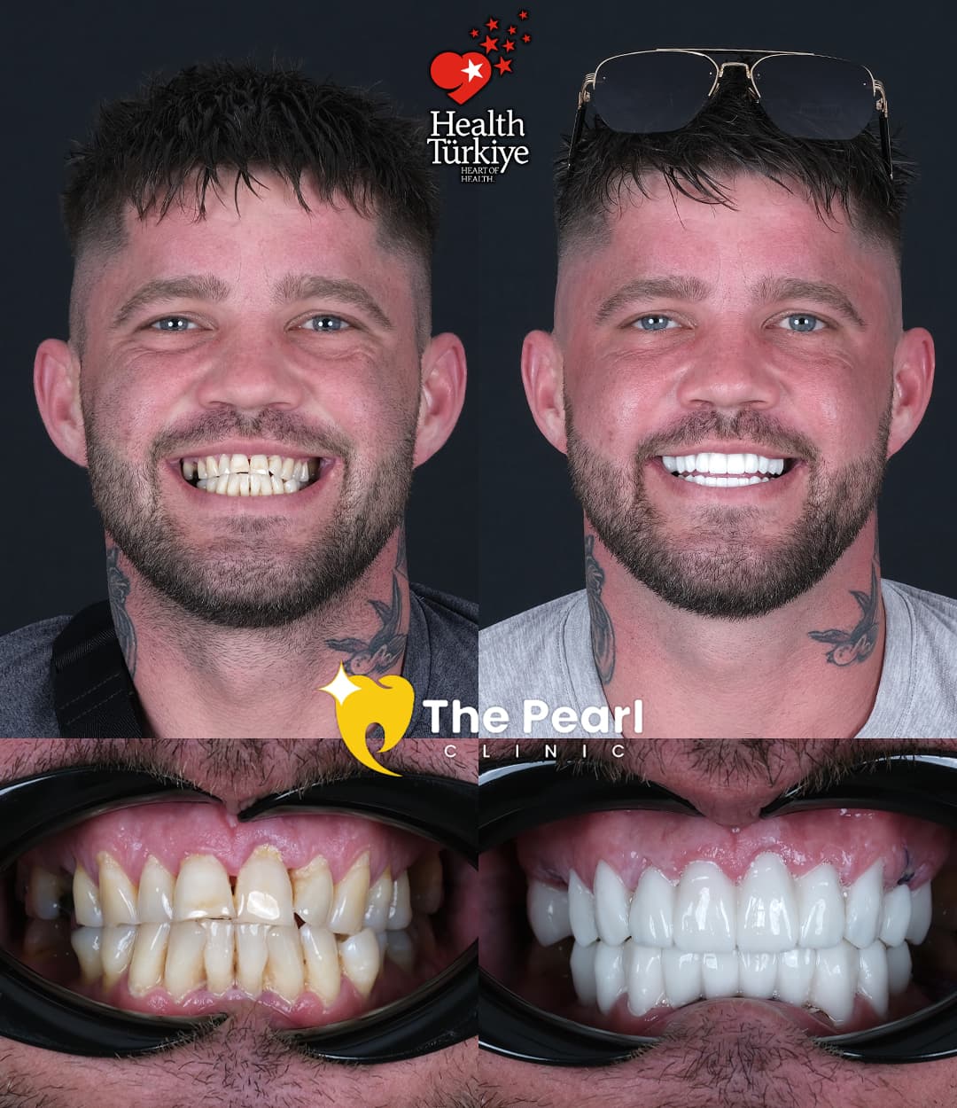 Temporary-Provisional Crown