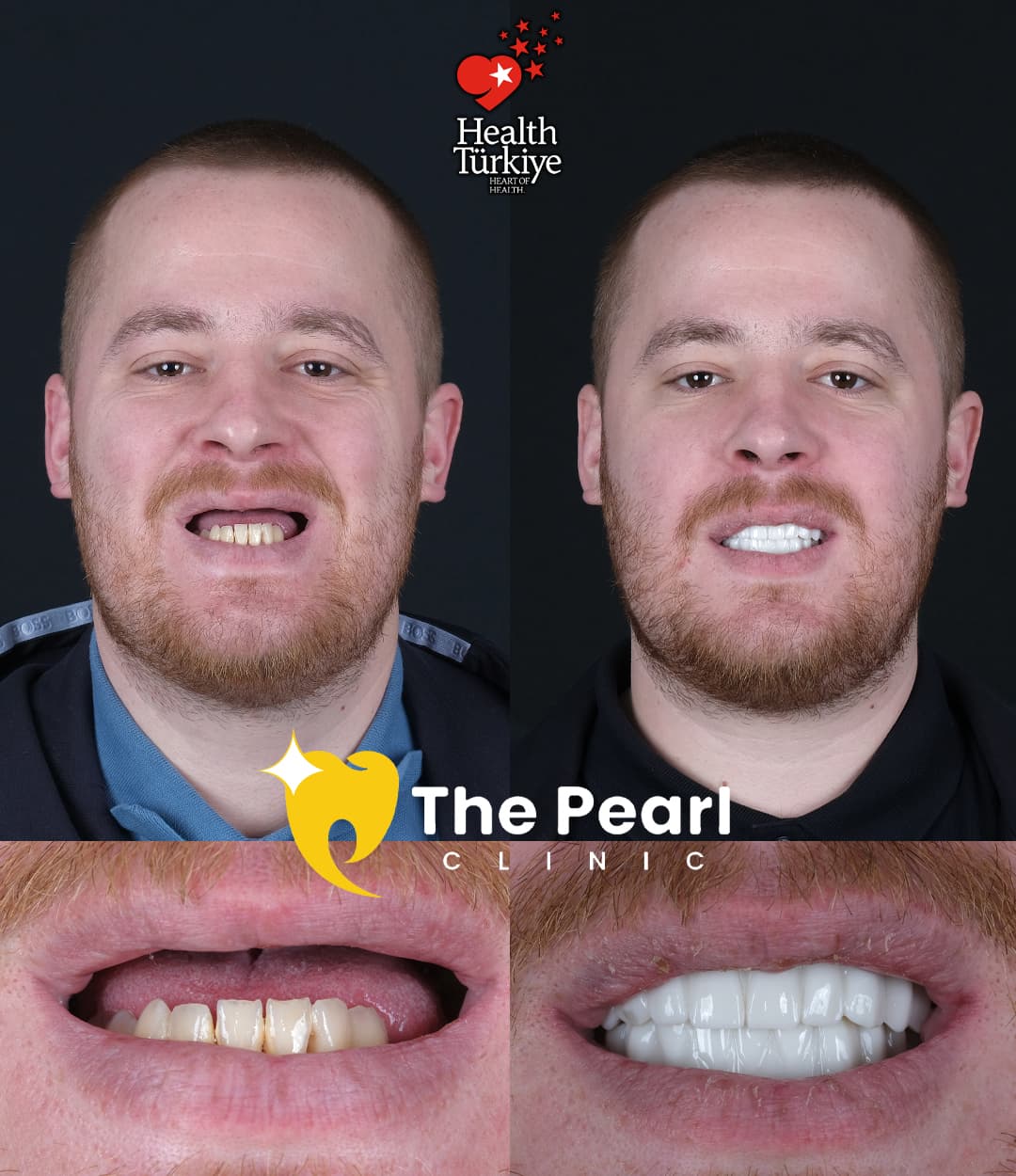 Temporary-Provisional Crown