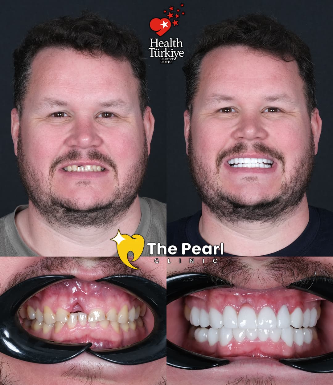 Zirconium Crowns