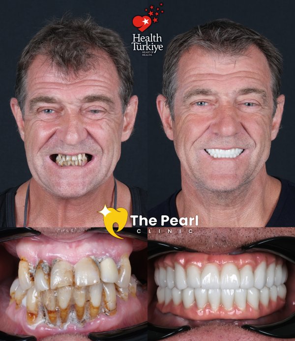 All-on-6  – 1M1 -Natural Style