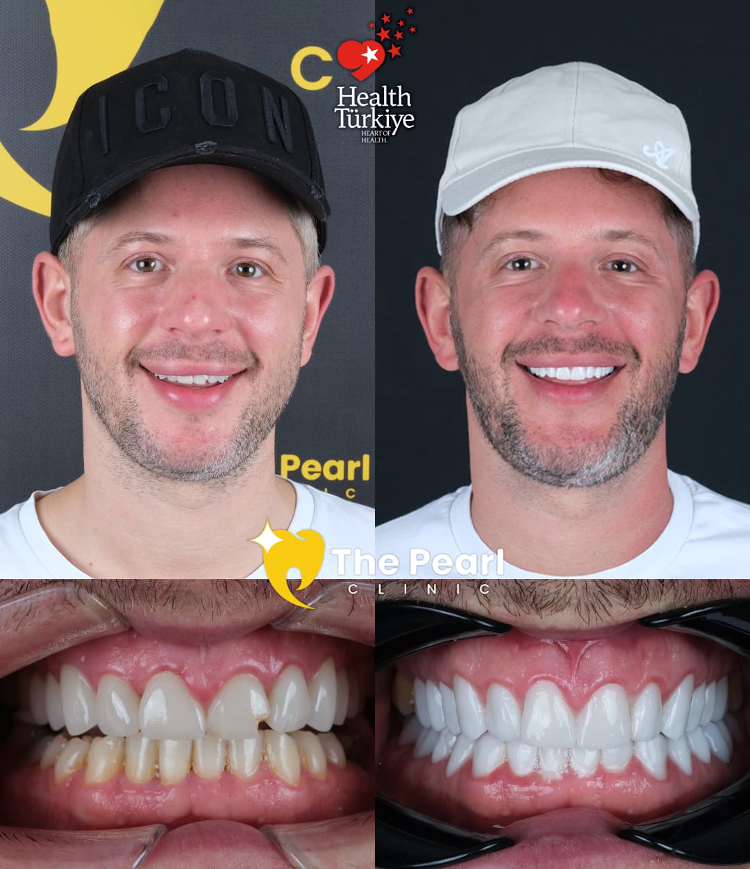 Laminate Veneer – BL2 -Natural Style