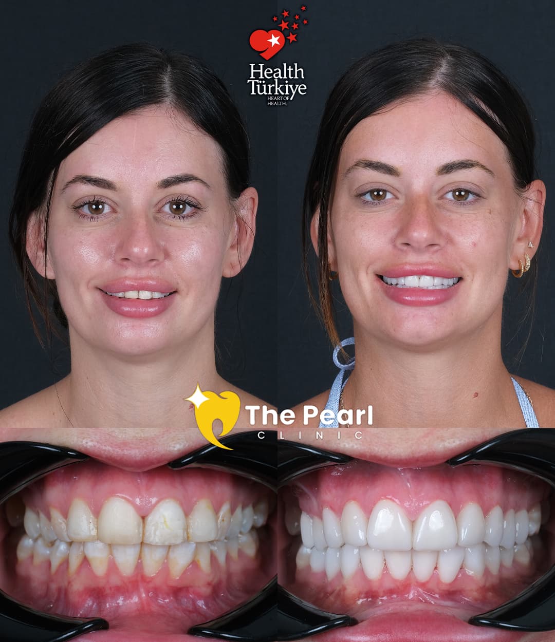 Laminate Veneer – BL2 -Natural Style