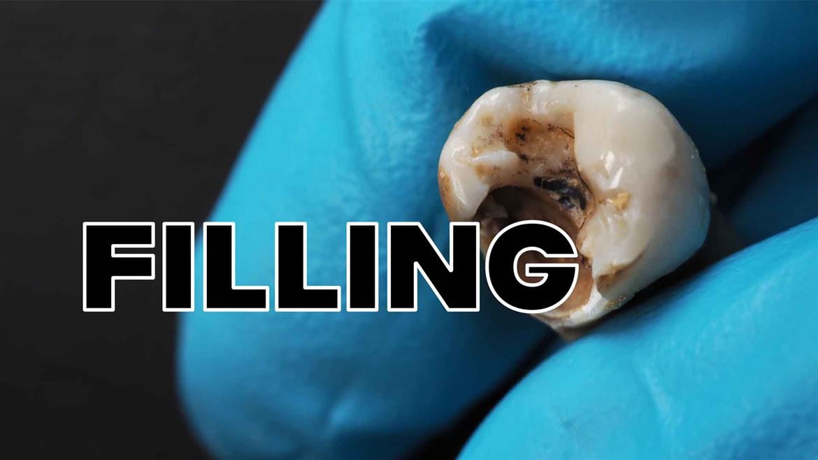 Don’t Lose Your Natural Teeth to Decay!