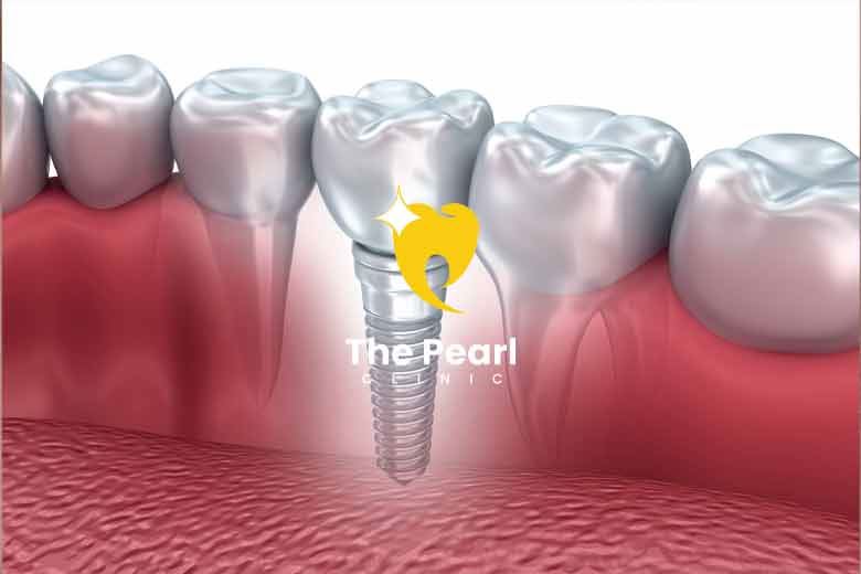 How Many Dental Implants Can You Get at Once?